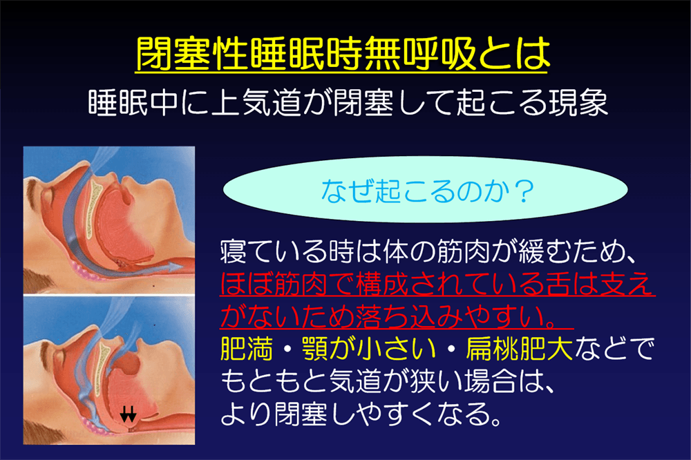 閉塞性睡眠時無呼吸とは